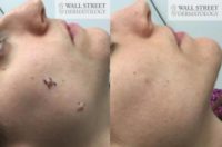 35-44 year old woman treated with Mole Removal
