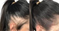 Woman treated with Scalp Micropigmentation