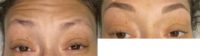 18-24 year old woman treated with Microblading