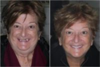45-54 year old woman treated with All-on-4 Dental Implants