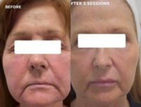 55-64 year old woman treated with Skin Tightening
