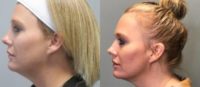 38 year old woman treated with Kybella