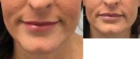 35-44 year old woman treated with Injectable Fillers in Lips
