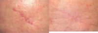 25-34 year old woman treated with Fraxel for Scar Removal