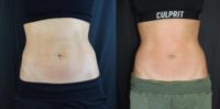 18-24 year old woman treated with Emsculpt