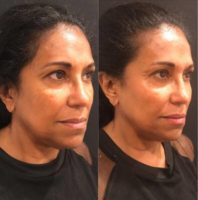 35-44 year old woman treated with Non Surgical Face Lift