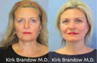 45-54 year old woman treated with Facial Enhancements