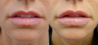 34 year old women treated with Juvederm Ultra XC
