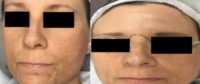 35-44 year old woman treated with Laser Genesis