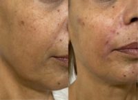 65-74 year old woman treated with Cheek Fillers, Chin Fllers, Nasolabial filler