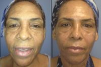 female treated for wrinkles