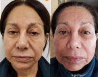 65-74 year old woman treated with ProFractional Laser