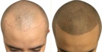 Man treated with Scalp Micropigmentation