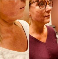 Woman treated with Nonsurgical Facelift