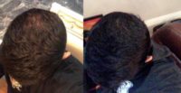 PRP Injections for thinning hair