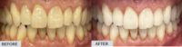 Patient treated with Invisalign